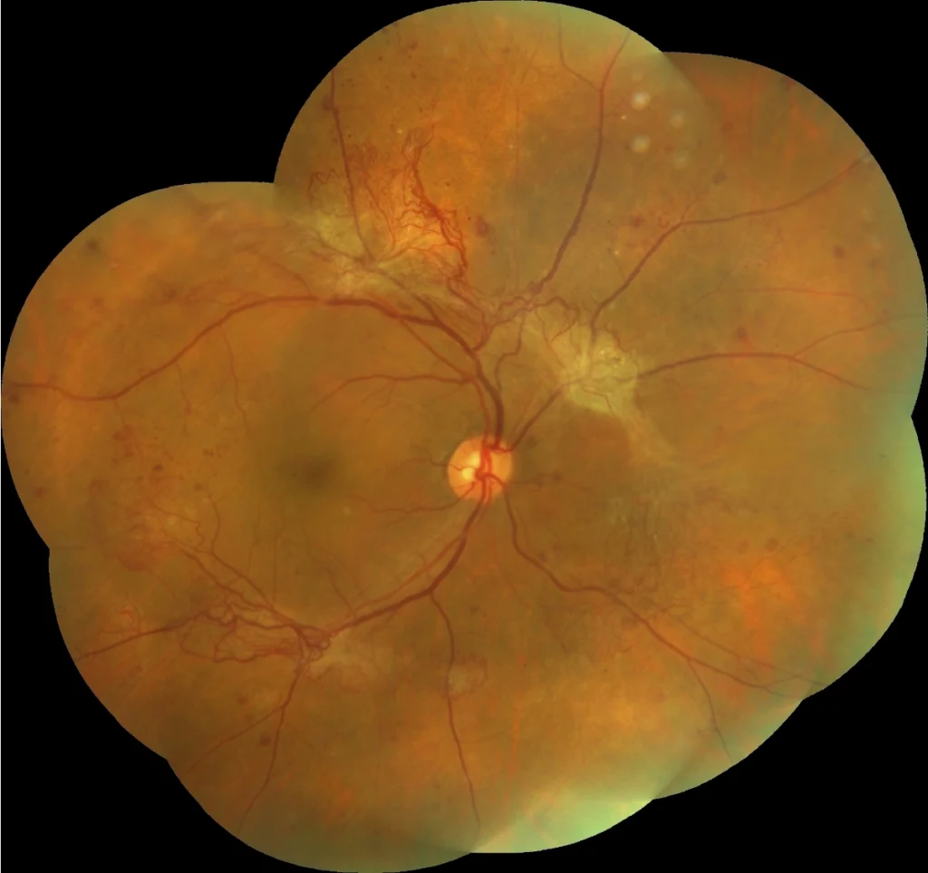 Diagram showing the retina and why retinal care is essential