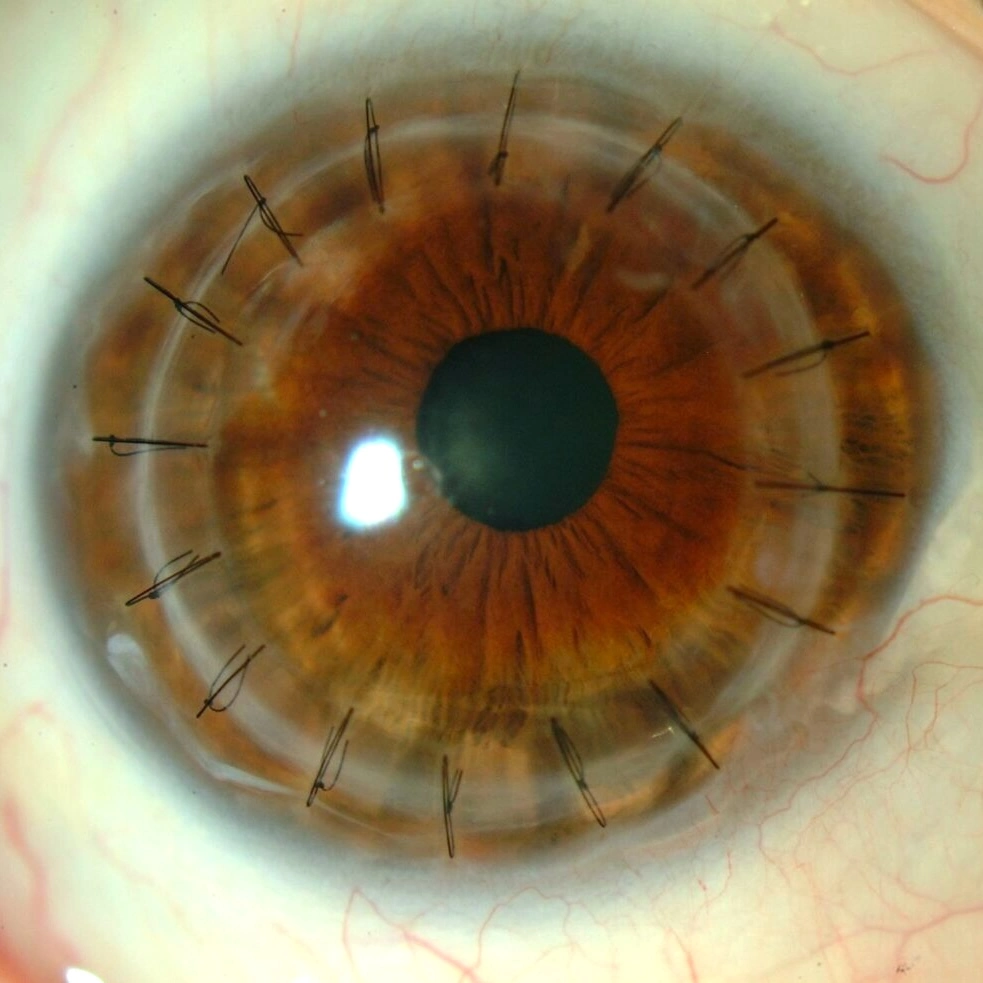 Cornea transplant surgery being performed by Dr. Krati Gupta in Bhopal to restore vision in a patient with corneal opacity.