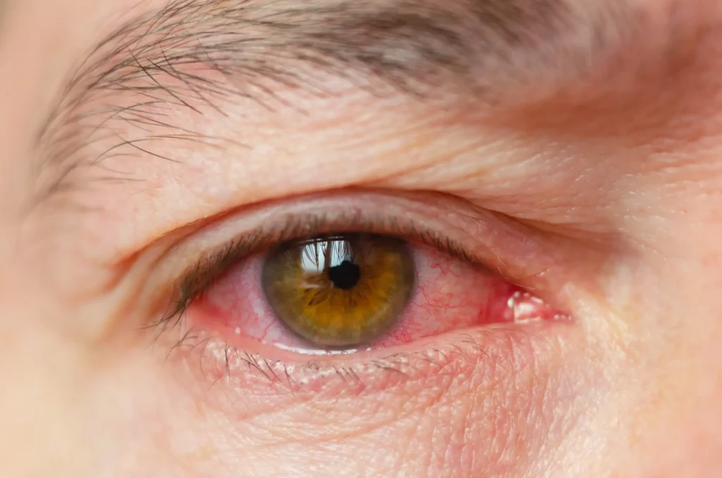 Image showing uveitis with visible inflammation in the eye.