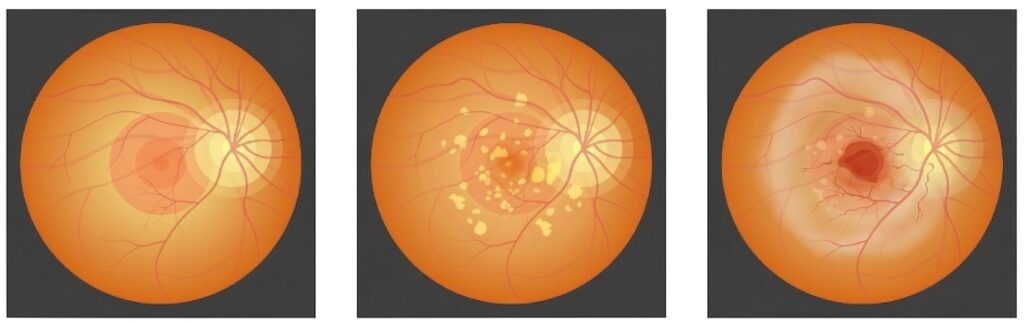 Age related macular degeneration bhopal