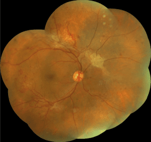 Diabetic retinopathy treatment bhopal