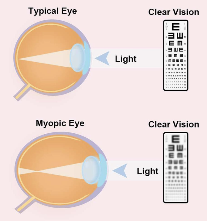 Myopia bhopal